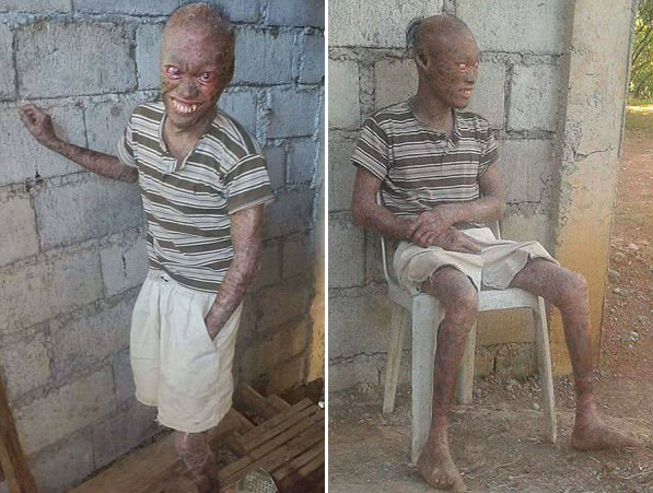 菲律宾一男子患罕见皮肤病被视作邪恶鬼怪