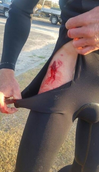 澳冲浪者遭大白鲨袭击被咬伤幸运逃脱